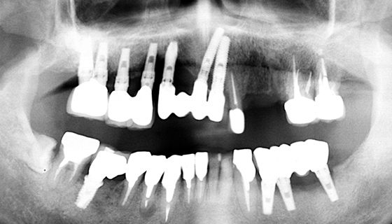 歯根破折と根面う蝕で左上の歯を抜歯し、インプラント