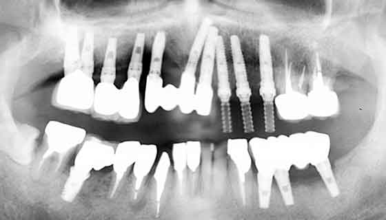 歯根破折と根面う蝕で左上の歯を抜歯し、インプラント