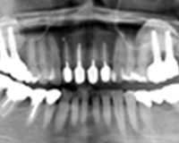 上顎臼歯部のインプラント症例1