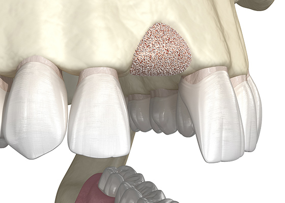 歯周病で骨が無くなり過ぎると、インプラントはできなくなる