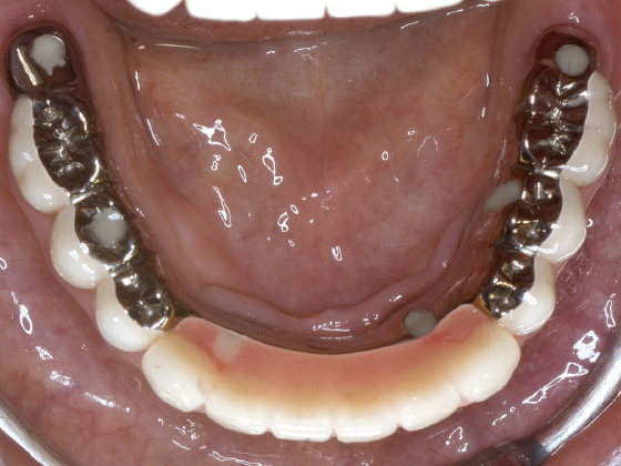 最終的に人工歯が入った状態