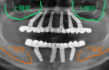 オールオン4のメリット デメリット 吉岡歯科医院 愛知県名古屋市中川区の歯医者 吉岡歯科医院