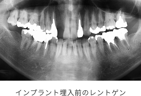 最終補綴物