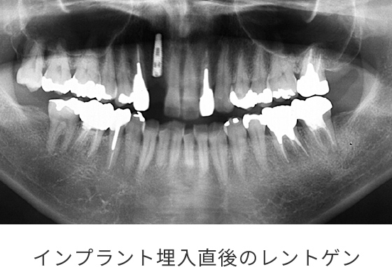 最終補綴物