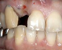 前歯のインプラント症例1