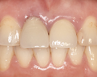 前歯のインプラント症例2