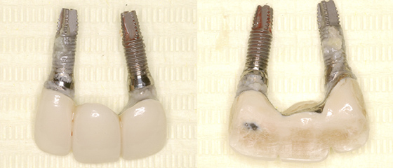 上顎前歯部を再インプラント