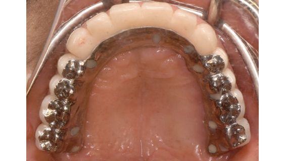 下顎にインプラント埋入→連結