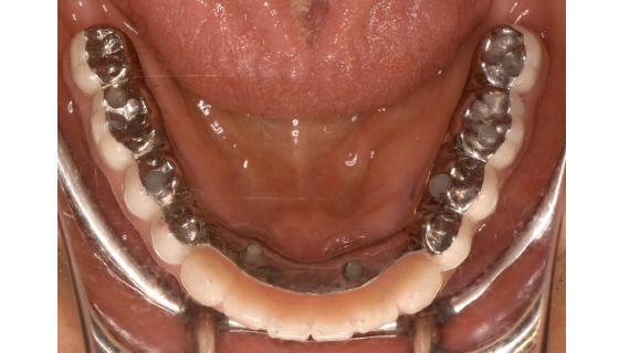 下顎にインプラント埋入→連結