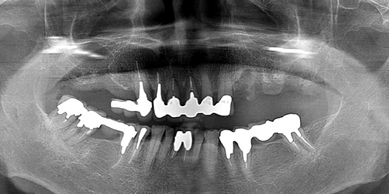 上顎をオールオン4で修復