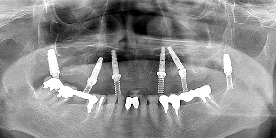 上顎をオールオン4で修復