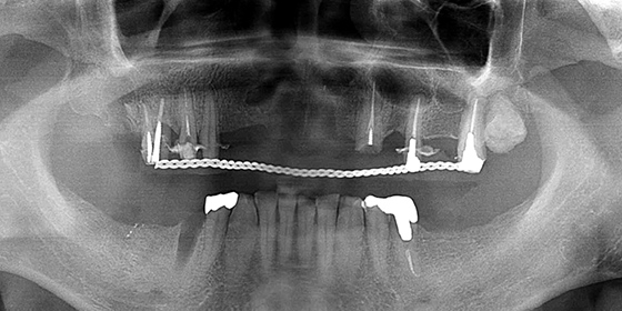 上顎をオールオン4で修復