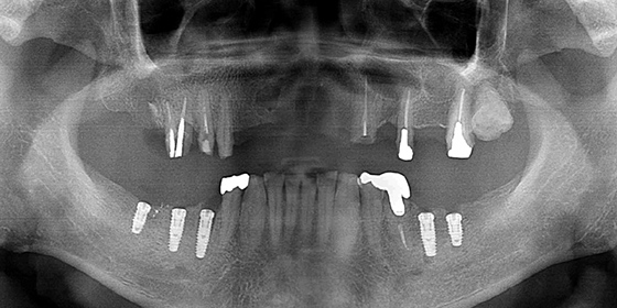 下奥歯のインプラント