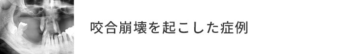 咬合崩壊を起こした症例