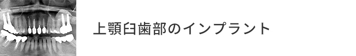 上顎臼歯部のインプラント症例