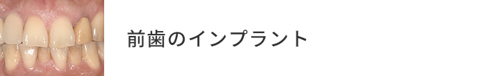 前歯のインプラント