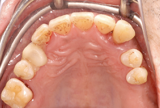 上の歯の抜歯