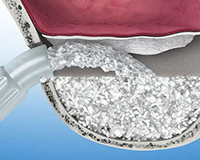 上顎臼歯部のインプラント症例2