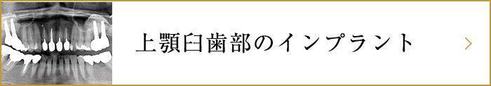 上顎臼歯部のインプラント