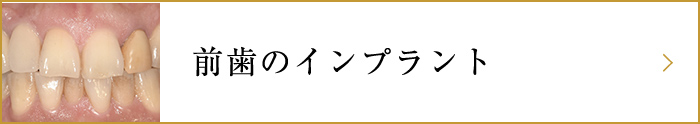 前歯のインプラント