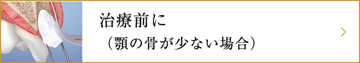 インプラント治療前に