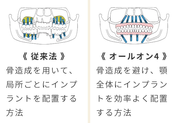 骨造成手術