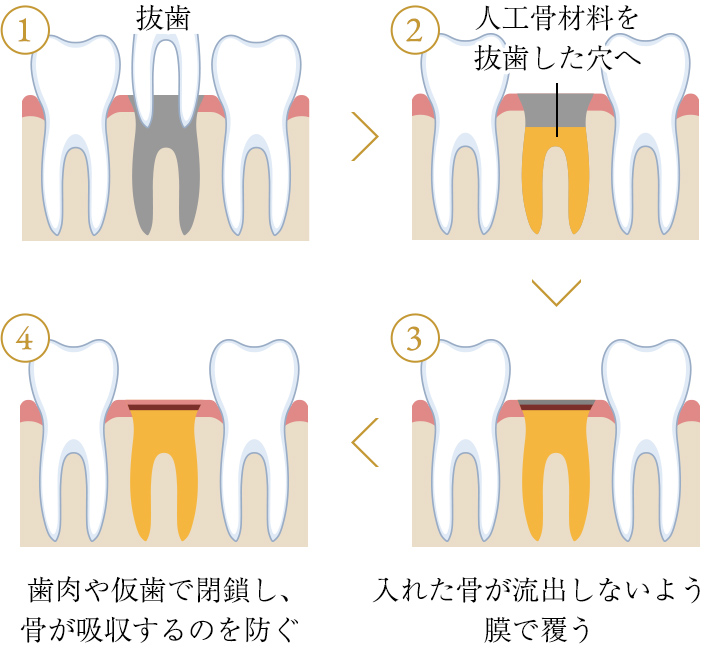 ソケットプリザベーション