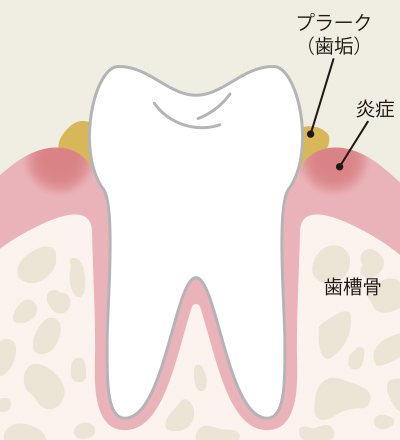 歯肉炎