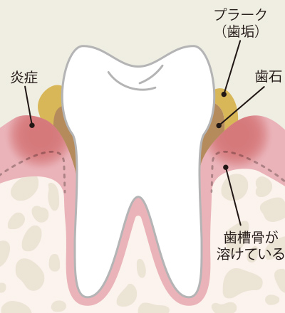 歯周炎