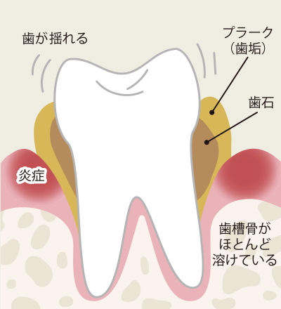 重い歯周炎