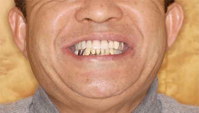 9ヶ月後上顎の前歯に人工歯を装着
