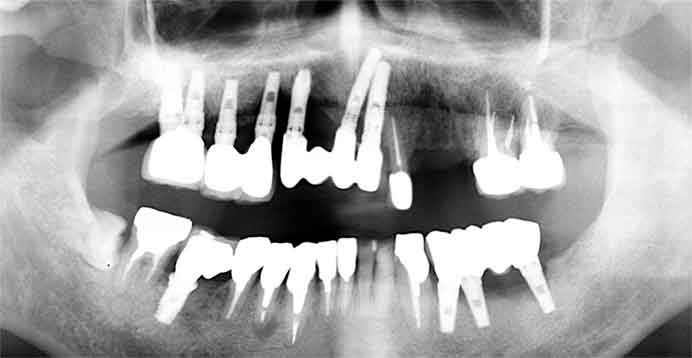 歯根破折と根面う蝕で左上の歯を抜歯しインプラント
