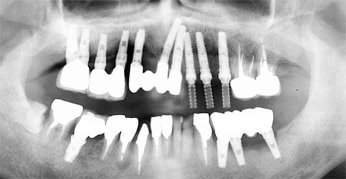 歯根破折と根面う蝕で左上の歯を抜歯しインプラント