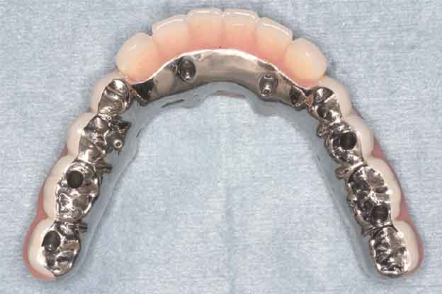 最終的な人工歯