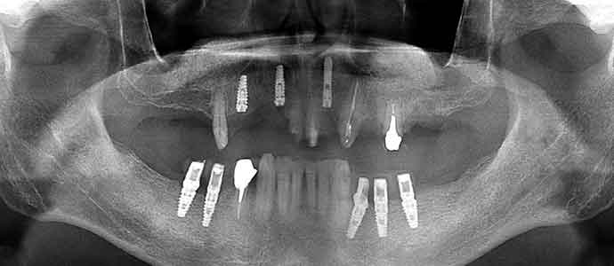 上顎に両側のサイナスリフトと前歯部のインプラント埋入