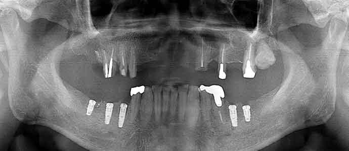 下奥歯のインプラント