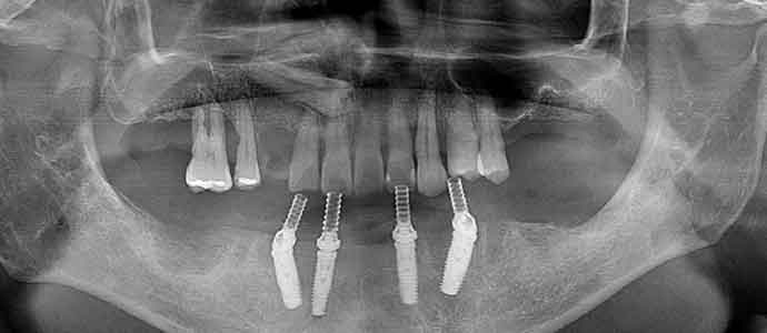 下の歯の抜歯後インプラント