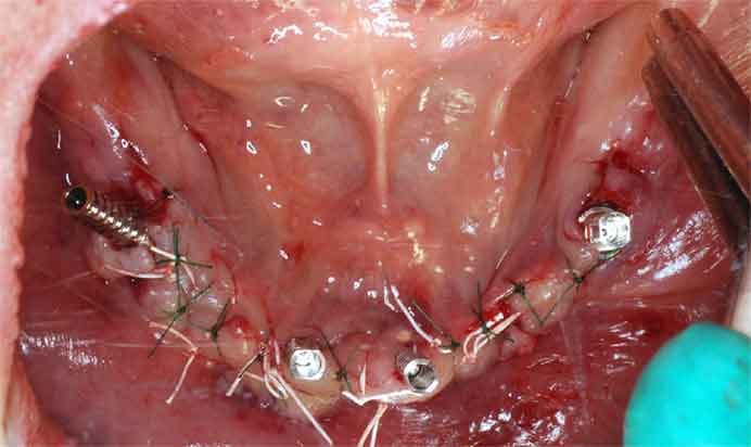 下の歯の抜歯後インプラント