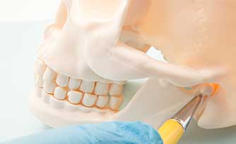 歯周病で骨が無くなり過ぎると、インプラントはできなくなる