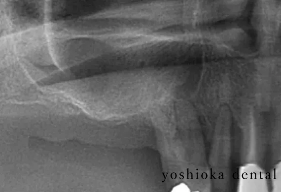 骨造成before