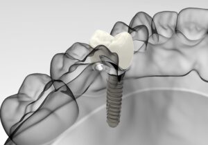 implant_cleaning_02