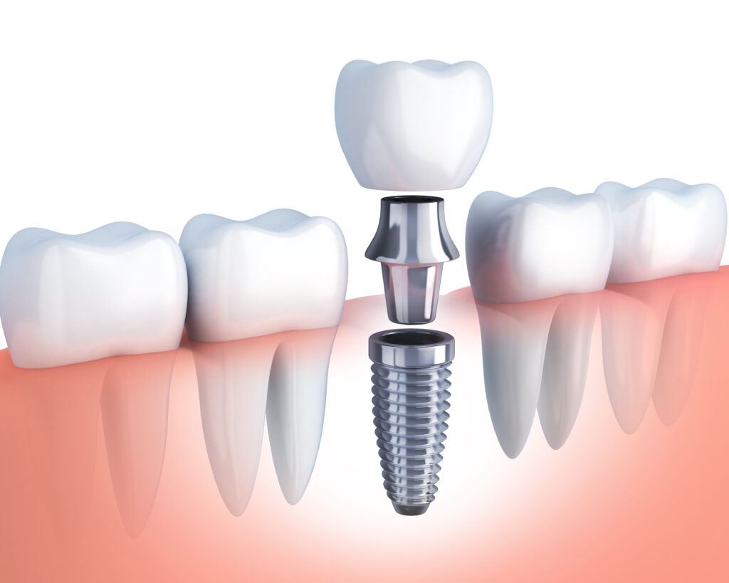 basshisokuji_implant_01