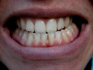 cause_of_gum_disease_02