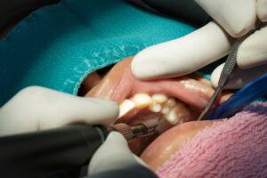 gum_disease_periodontitis_01