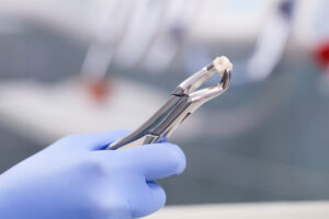 dental_extraction_02