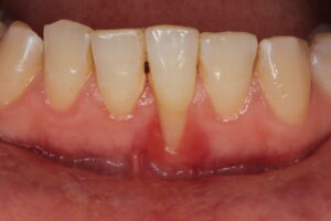 gum_disease_periodontitis_02