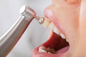 periodontitis_cleaning_02